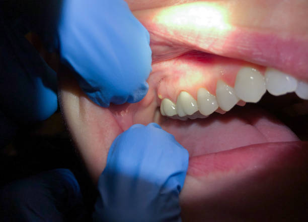 Best Emergency Wisdom Tooth Extraction in Summersville, WV